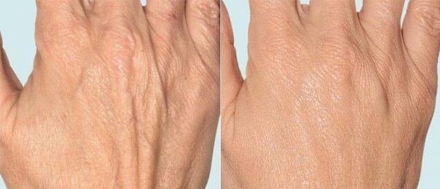 Pel das mans antes e despois da terapia fraccionada
