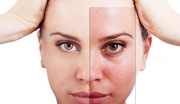 O rexuvenecemento fraccionado elimina as principais imperfeccións estéticas da cara