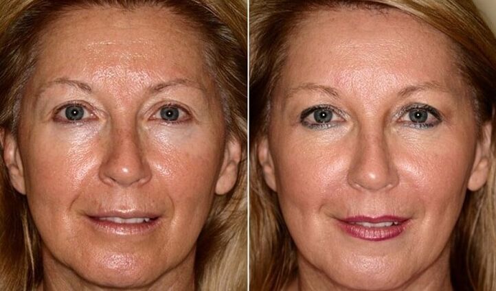 antes e despois do rexuvenecemento da pel facial na casa