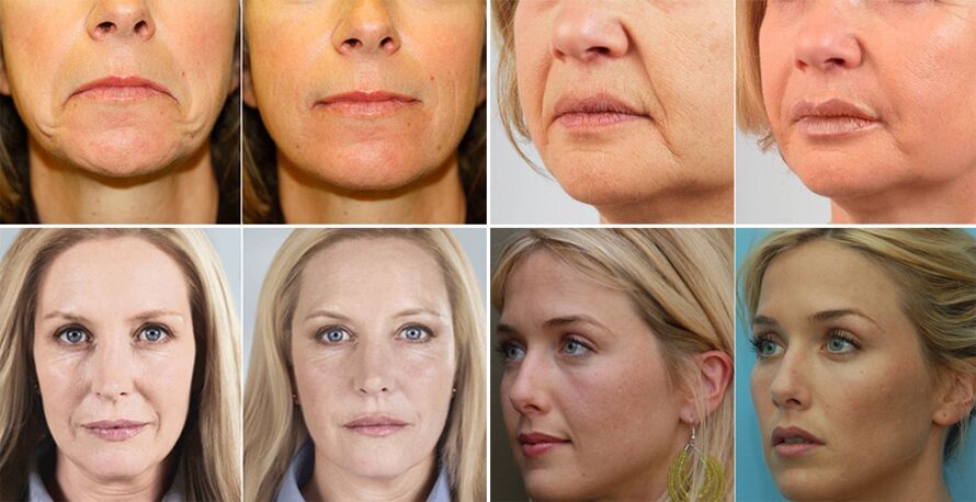 Fotos de mulleres antes e despois do rexuvenecemento da pel facial