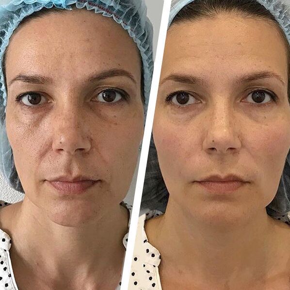 Foto da cara antes e despois do rexuvenecemento con láser